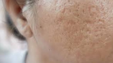 acne scar image