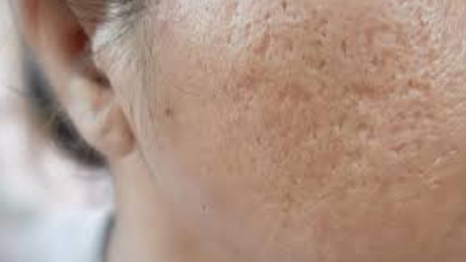 acne scar image